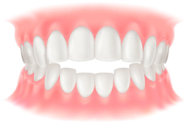 前歯で噛めない（開咬・かいこう）