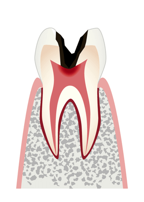 C3 神経まで進行したむし歯