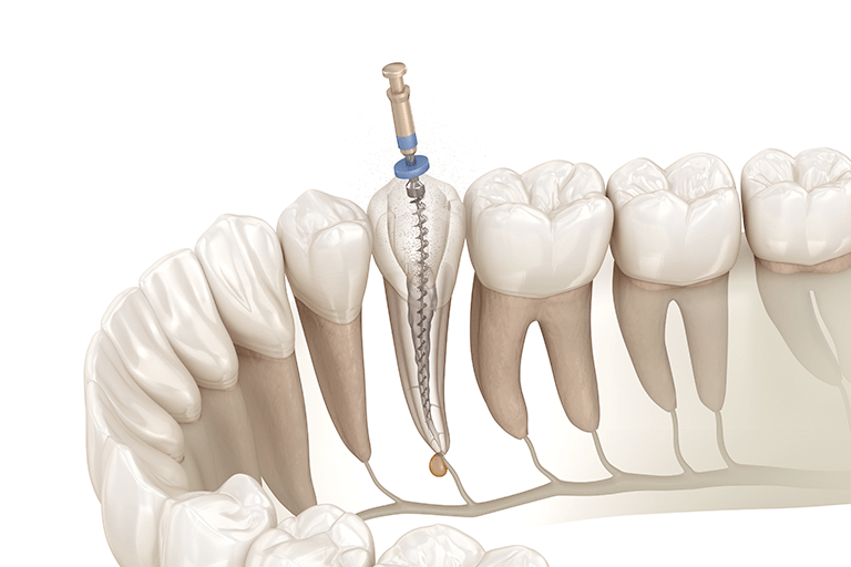根管治療（歯の神経の治療）