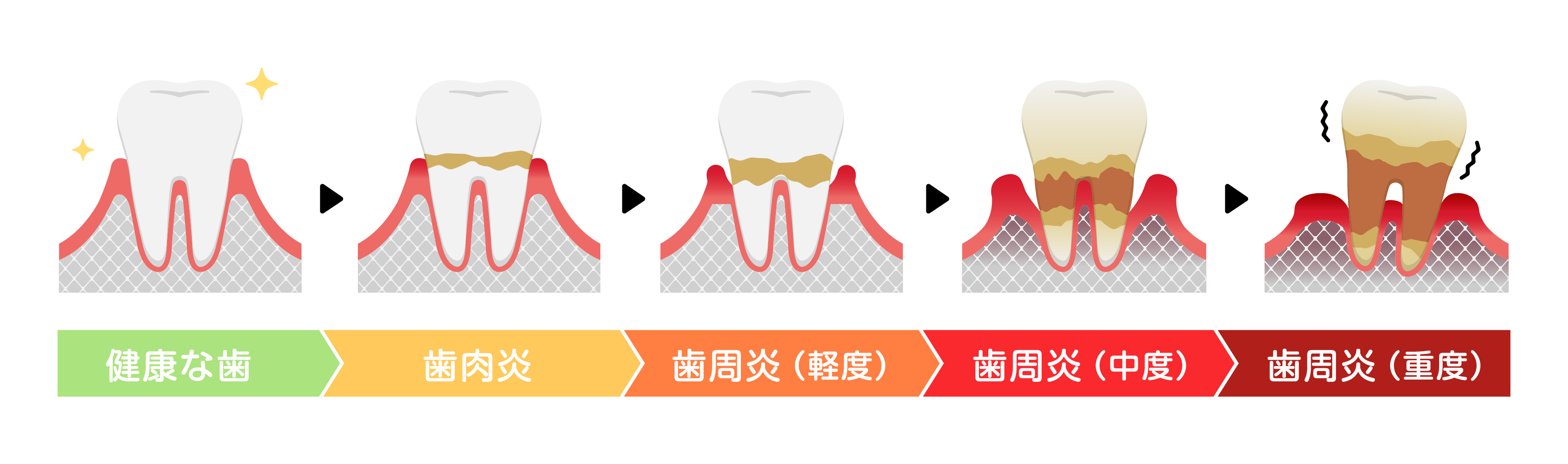 歯周病