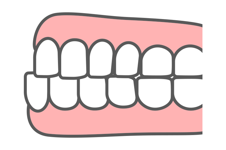 受け口のイラスト