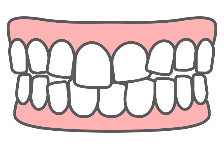 乱ぐい歯のイラスト