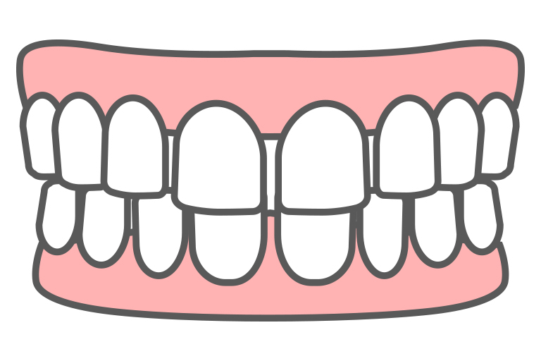 すきっ歯のイラスト