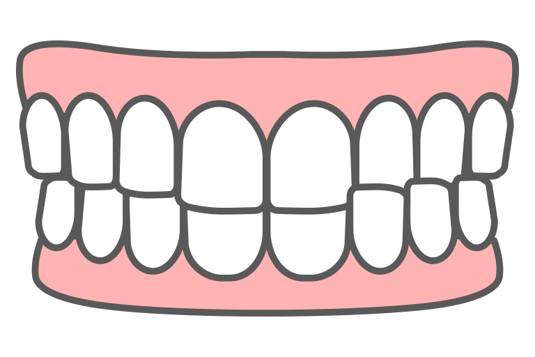 交叉咬合のイラスト
