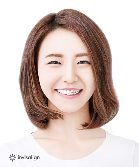 インビザラインのイラスト