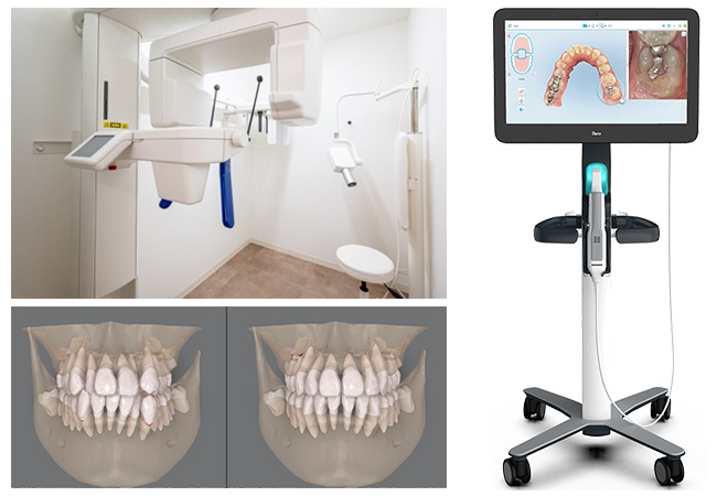 マウスピース矯正